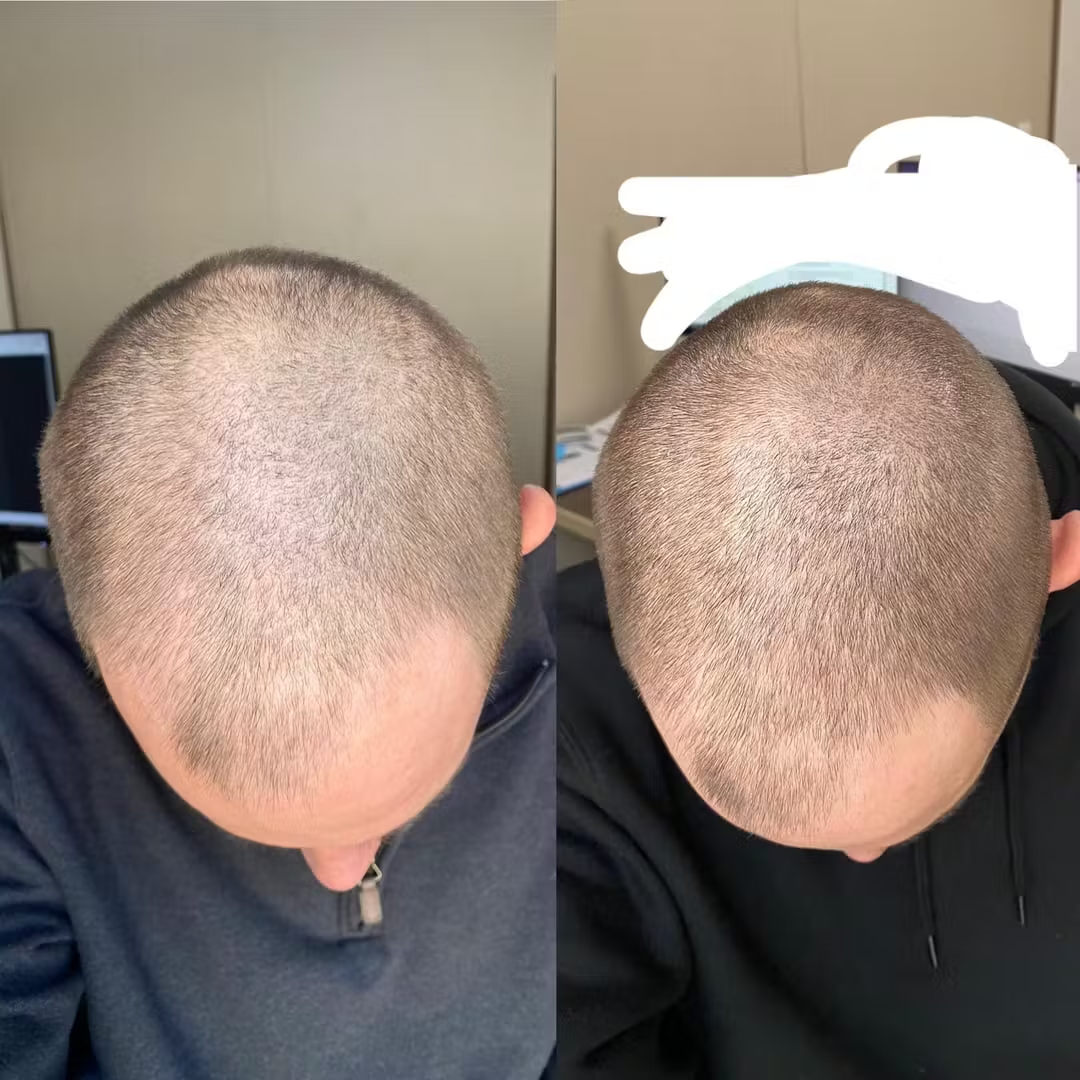 AlphaInfuse® Hair Regrowth System