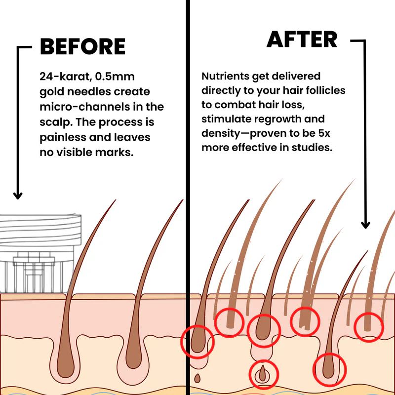 AlphaInfuse® Hair Regrowth System