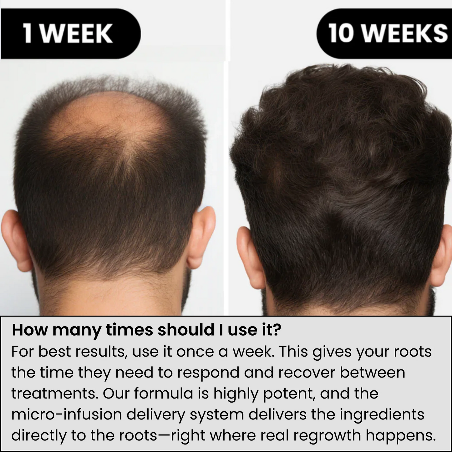 AlphaInfuse® Hair Regrowth System