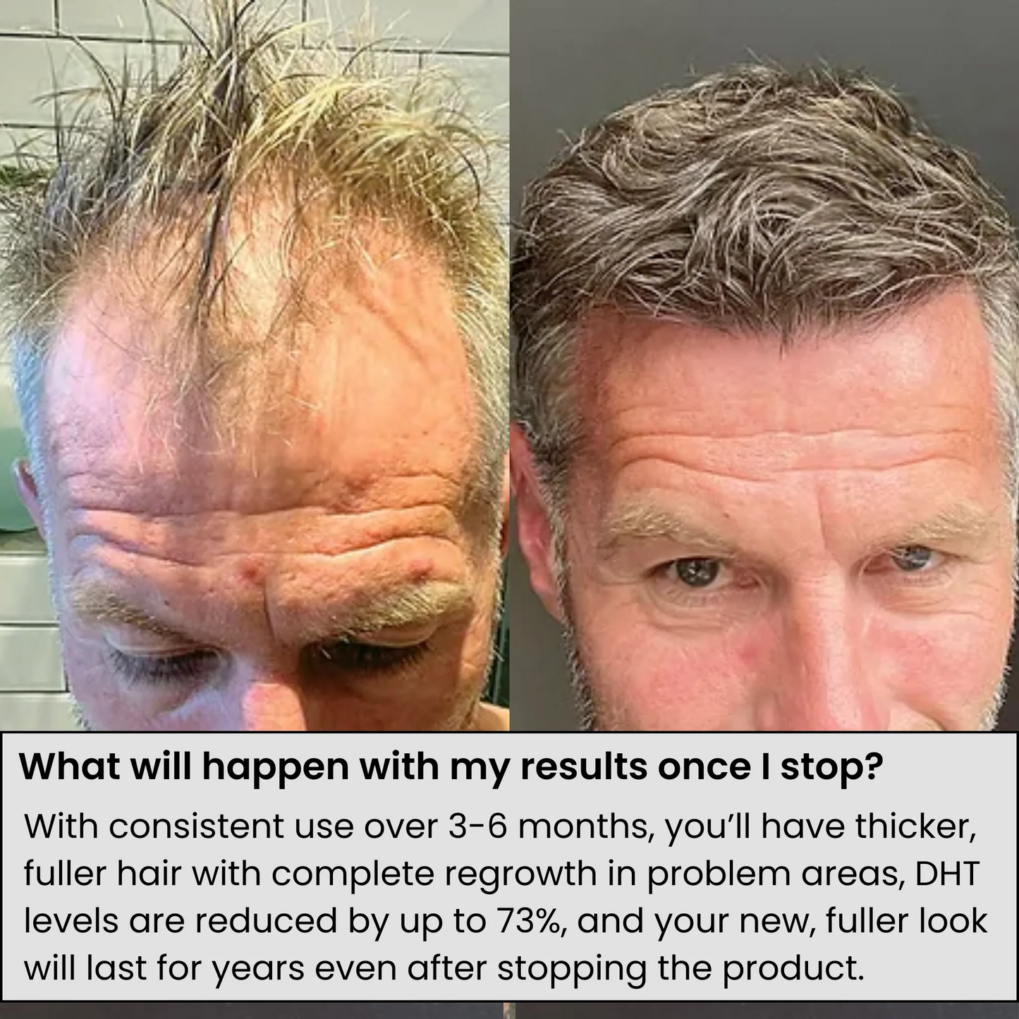 AlphaInfuse® Hair Regrowth System