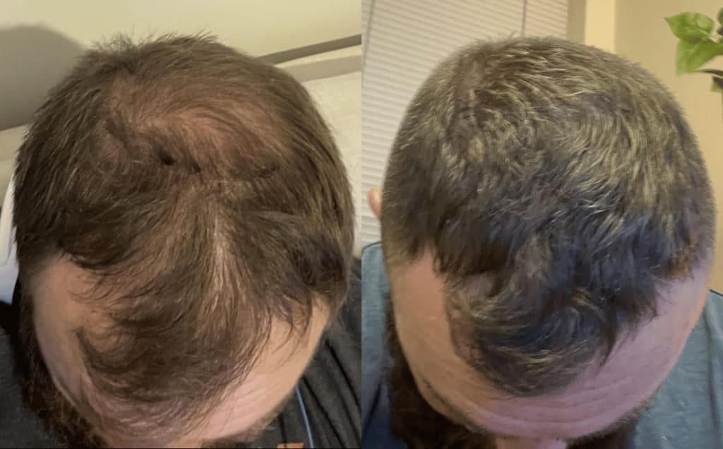Stop Hair Loss and Regrow Thicker Hair in Just Weeks