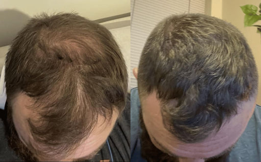 Folixera™ — Advanced Micro-Infusion Kit + Botanical Serums That Target Hair Loss at the Source